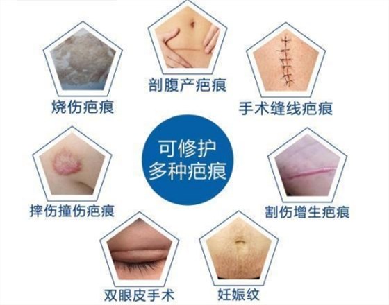 醫(yī)用疤痕貼適用范圍 醫(yī)用疤痕貼適用范圍